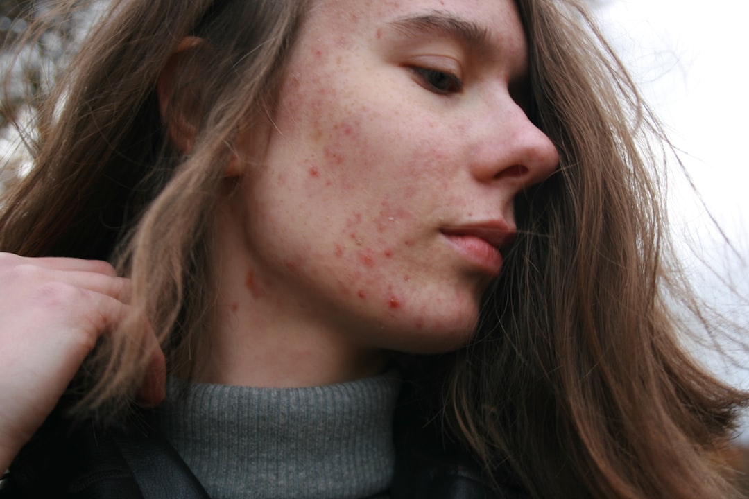 Akné, rosacea a alergia: spoznáš orientačne kožné stavy?